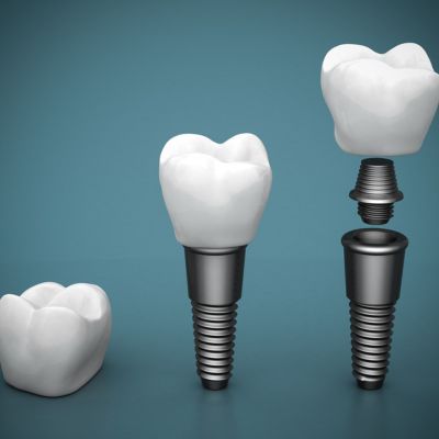 3D model of dental implants