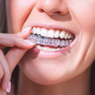 Woman with perfect smile wearing invisible dental aligners